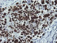 Carcinoma of Human bladder tissue stained with anti-MAGEA4 mouse monoclonal antibody (TA505362)