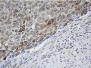 Carcinoma of Human bladder tissue stained with anti-MAGEB1 mouse monoclonal antibody (TA800473)
