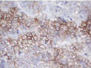 Adenocarcinoma of Human ovary tissue using anti-MAGEB18 mouse monoclonal antibody (TA502633)