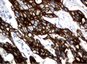 Cytokeratin 18 in adenocarcinoma of hu breast stained with UM500045