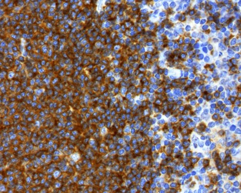 ihc-staining of FFPE human B-cell Lymphoma using Anti-CD19
