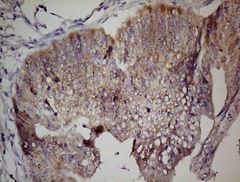 Human colon adenocarcinoma stained with anti-LGR5 monoclonal antibody (UM800102)