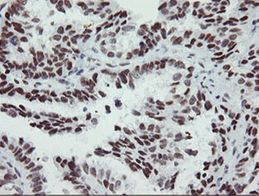Human ovary adenocarcinoma stained with anti-SENP2 monoclonal antibody (TA504817)