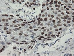 Human breast adenocarcinoma stained with anti-TLE1 monoclonal antibody (TA800294)