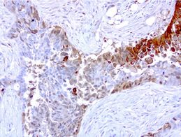 Human endometrial carcinoma stained with anti-MMP7 monoclonal antibody (UM800061)